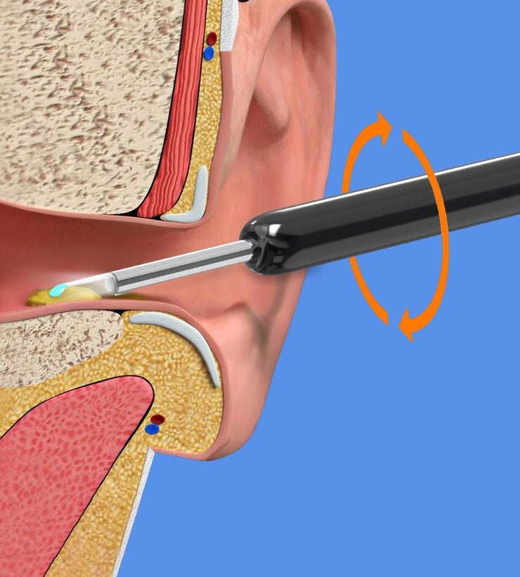 Illustration of a medical tool being inserted into an ear canal on a blue background